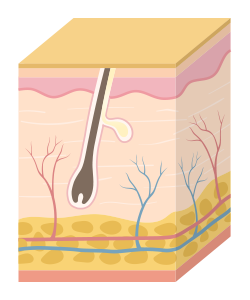 여드름 발생 과정 이미지
