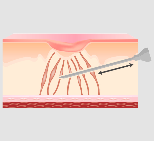서브시전 이미지