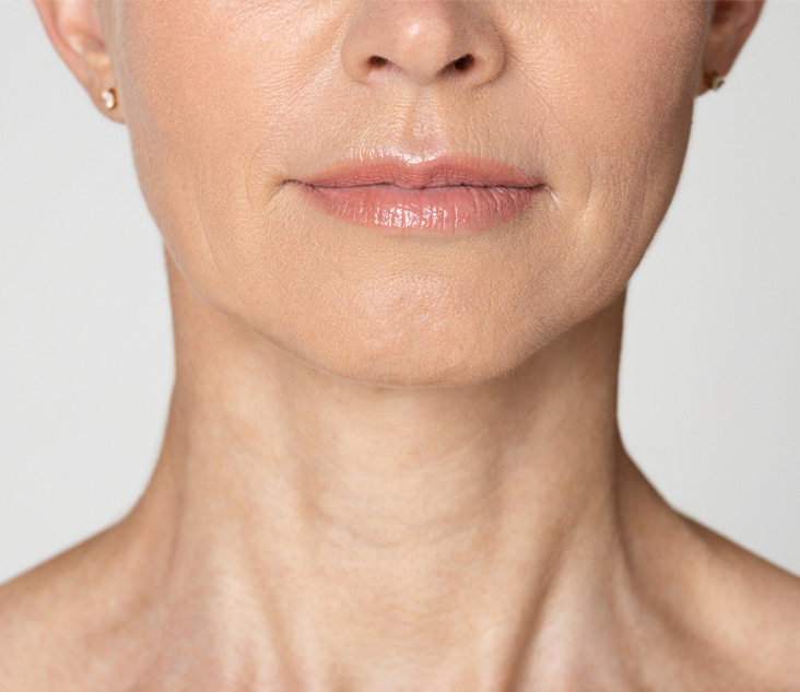 보톡스 효과 이미지